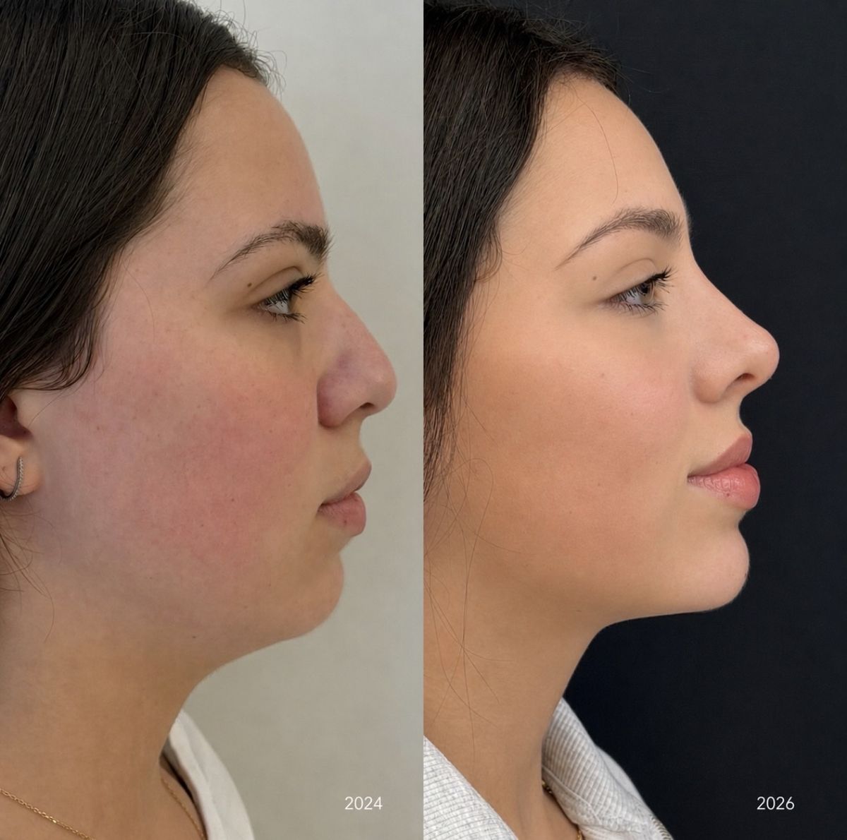 Antes e depois de planejamento full face, perfil