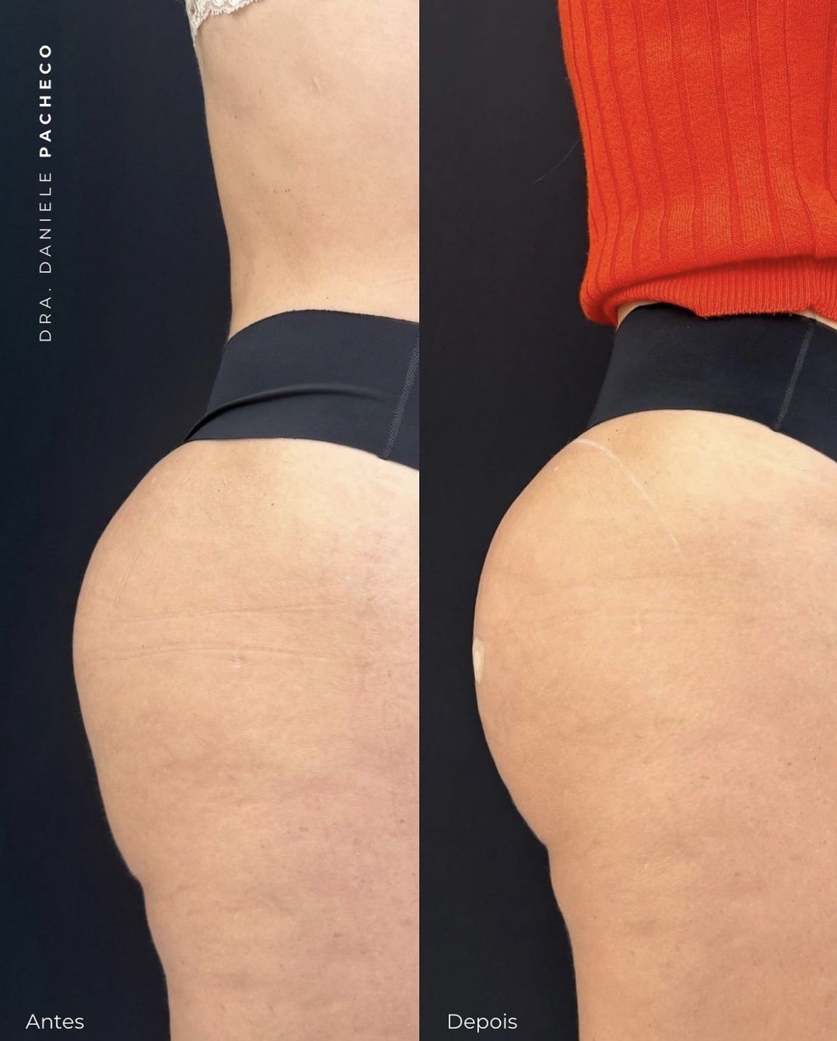 Antes e depois do protocolo Bumbum UP