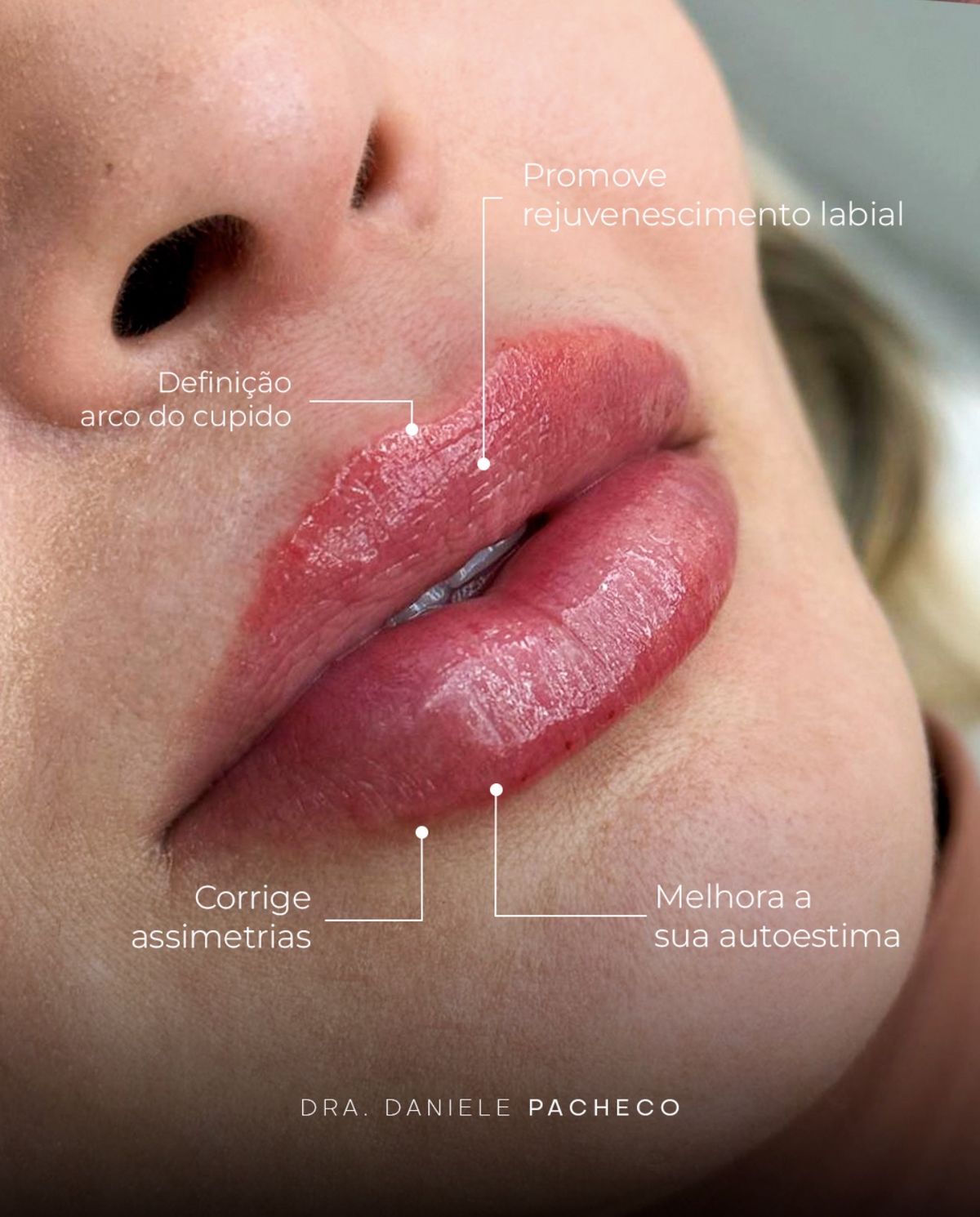 Detalhe de preenchimento labial com arco do cupido definido