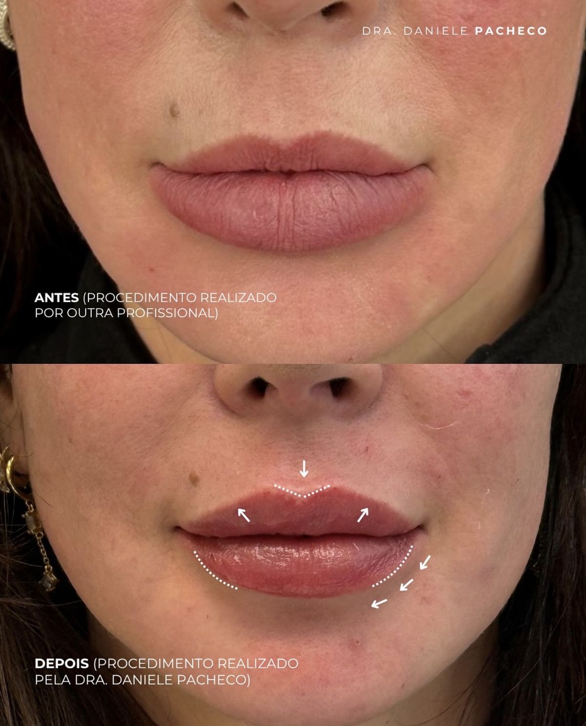 Antes e depois de correção de preenchimento labial